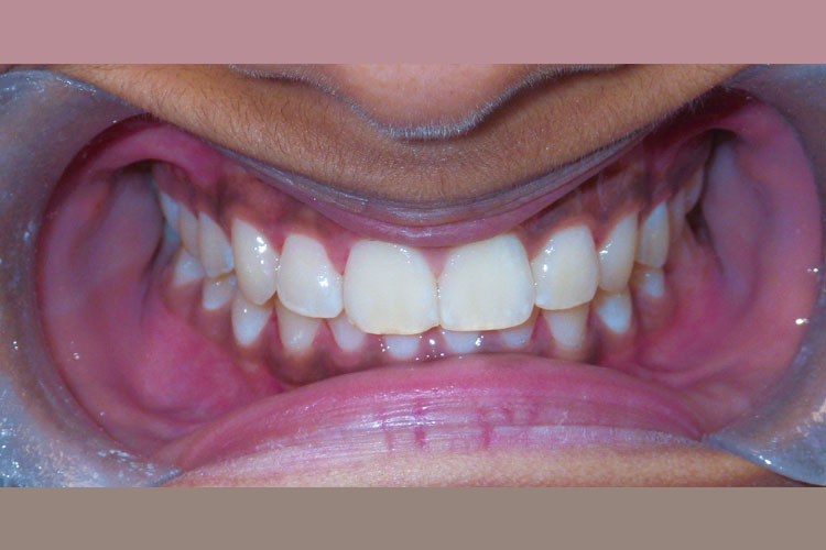 Invisalign Treatment - Teen (After Image)
