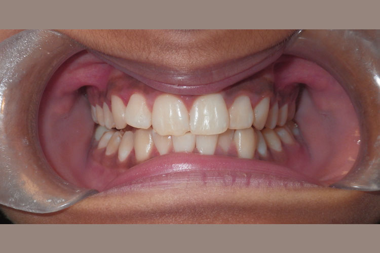 Invisalign Treatment - Teen (Before Image)