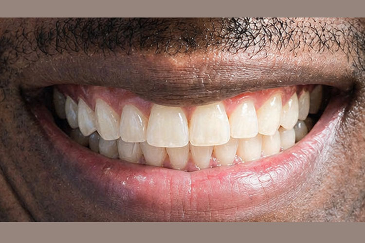 Invisalign Treatment - After Image