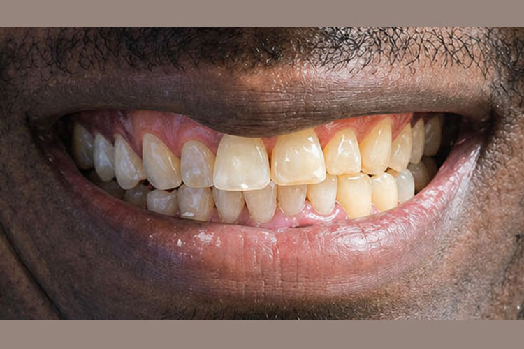 Invisalign Treatment - Before Image