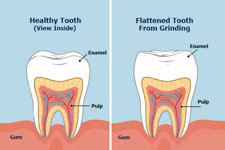 Signs of Teeth Grinding