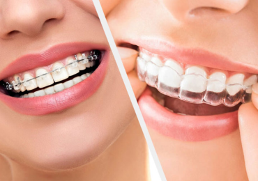 Why Invisalign Could Be Right for You?