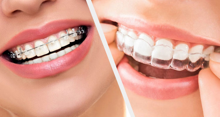 Why Invisalign Could Be Right for You?