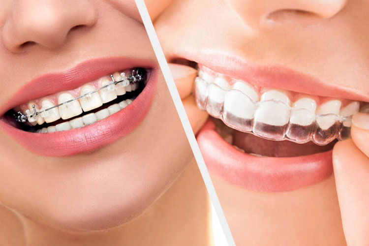 Why Invisalign Could Be Right for You?
