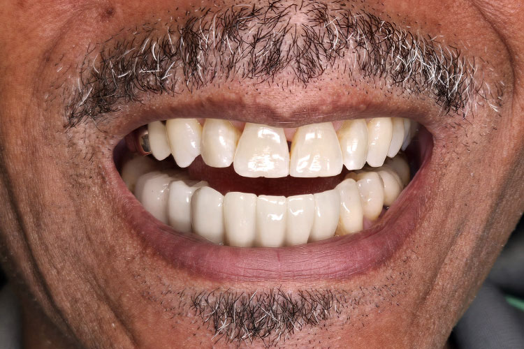 Dental Implant Bridge - After Image