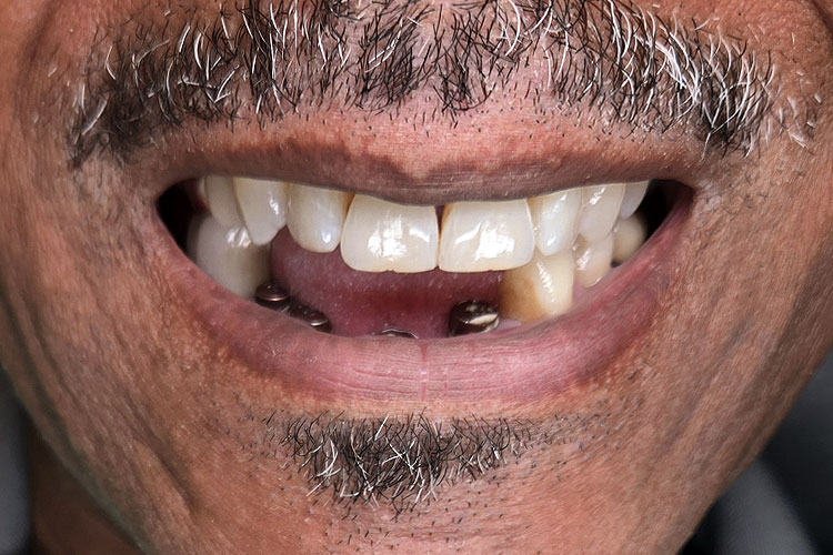 Dental Implant Bridge - Before Image