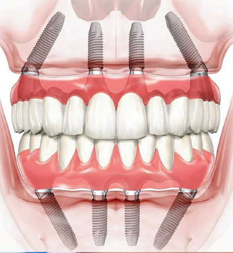 Dental Implant Treatment Process