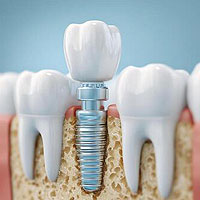 Dental Implants Benefits