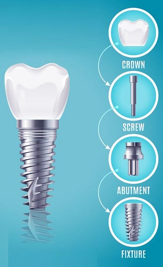Dental Implants Treatment