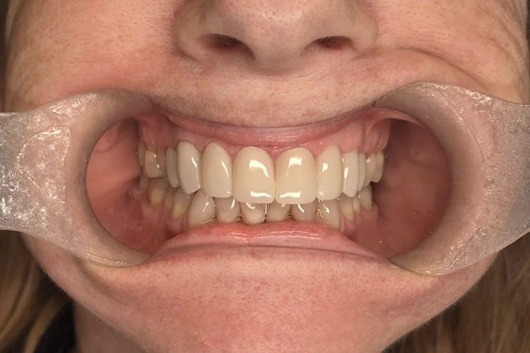 Digitally Designed Smile Makeover - After Image