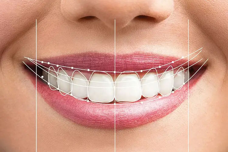 Full Mouth Rehabilitation