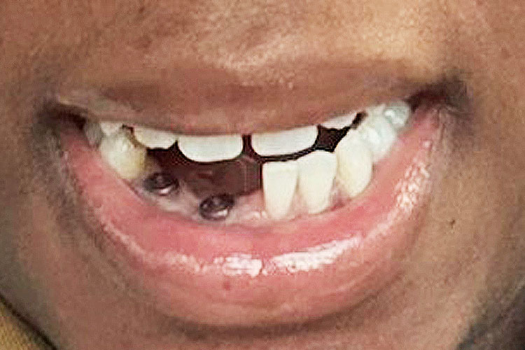 Lower Front Teeth Implant Bridge - Before Image