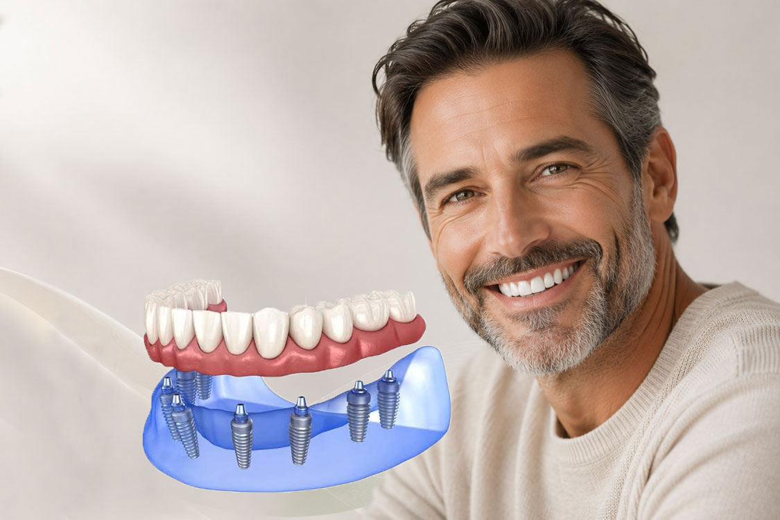Full Arch Implants