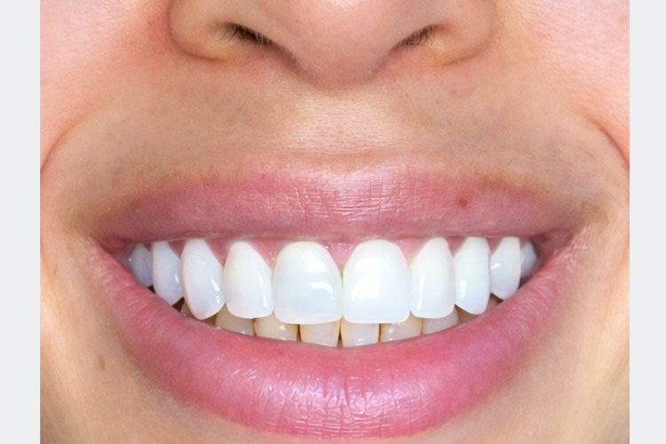 Smile Makeover (After)