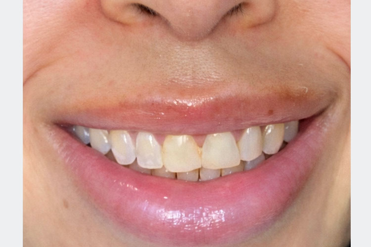 Smile Makeover (Before)