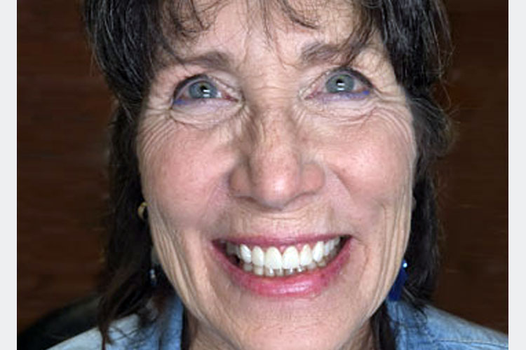 Smile Makeover With Zirconia Crowns (after image)