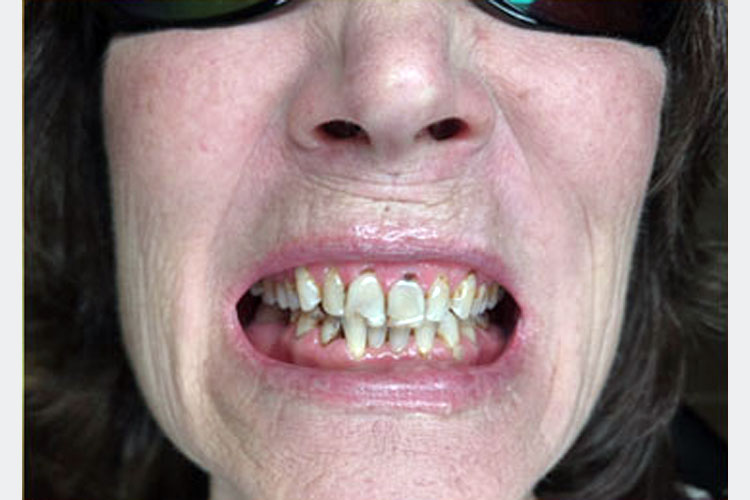 Smile Makeover With Zirconia Crowns (before image)