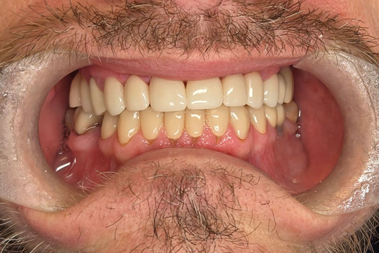 Upper Arch Cosmetic Rehab - After Image