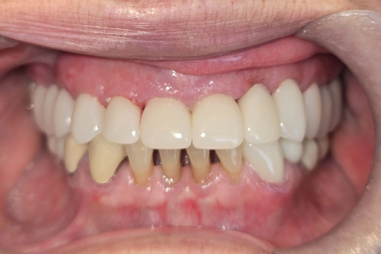 Upper Smile Make Over - After Picture