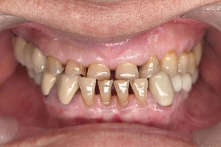 Ceramic Crowns (Upper Smile Make Over) - Before Image