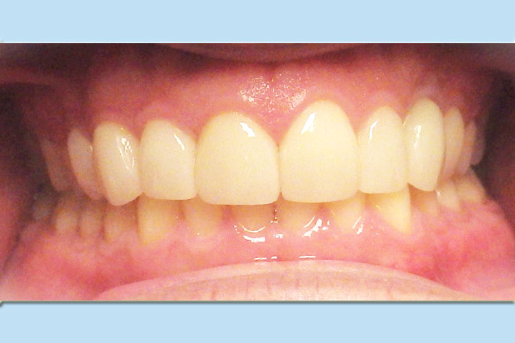Veneers - Cosmetic Dentistry - After Image