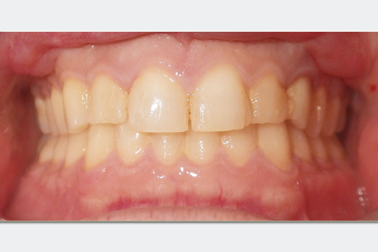 Veneers Case Before