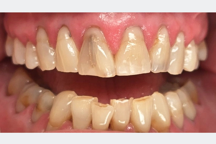 Zirconia Crowns: Upper Teeth - Before Picture
