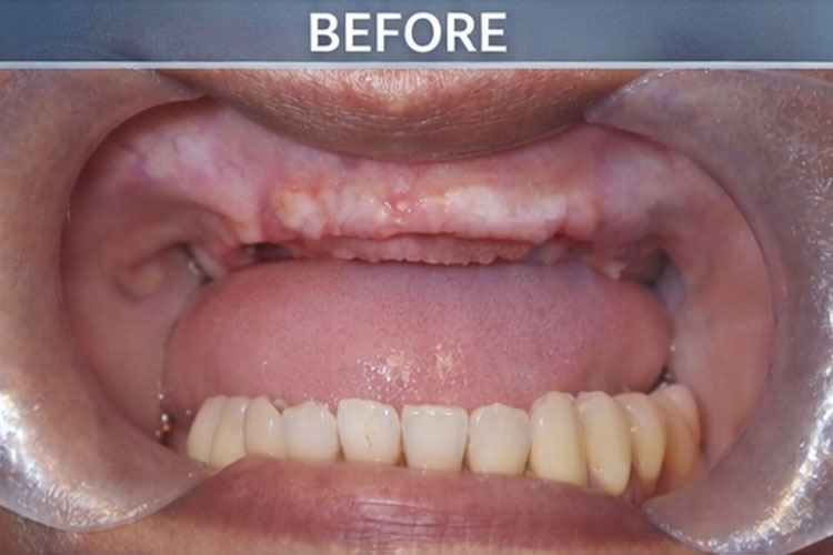 All-On-6 Implant -Before Image