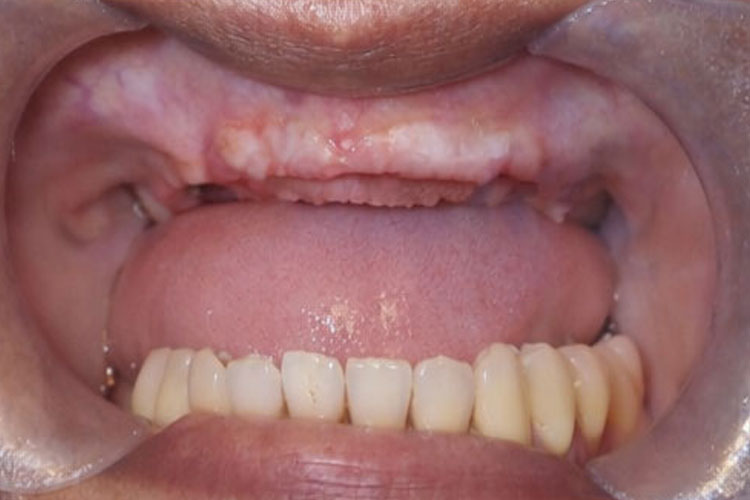 All-On-6 Upper Arch Implant - Before Image