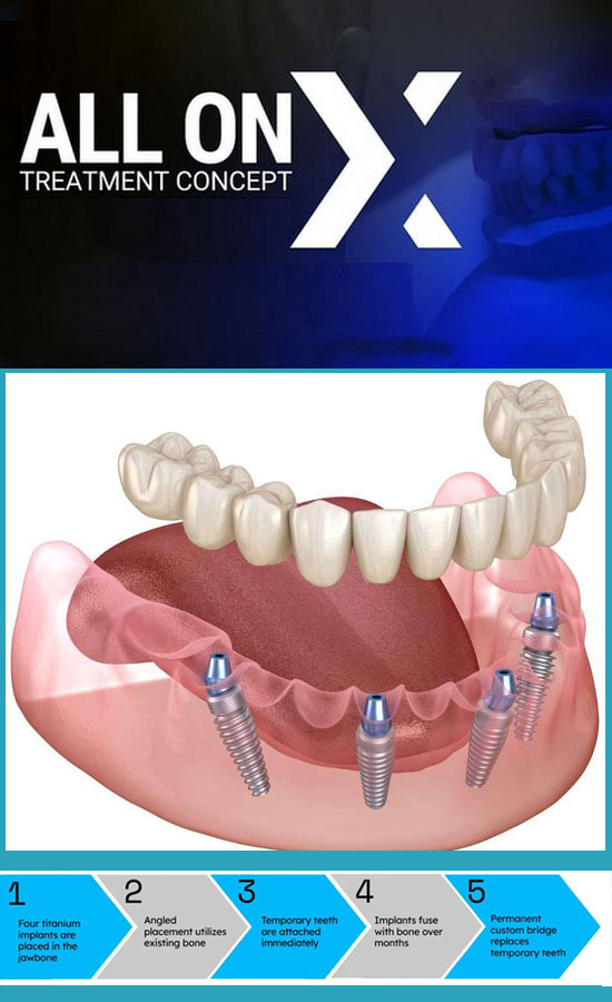 All-on-X Full-Mouth Implants