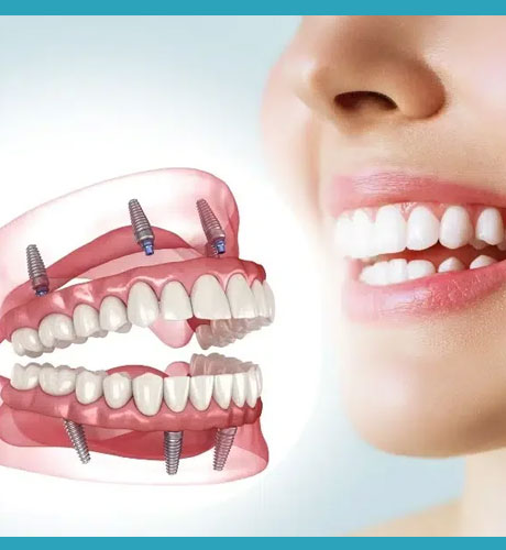 All-on-X Full-Mouth Implants