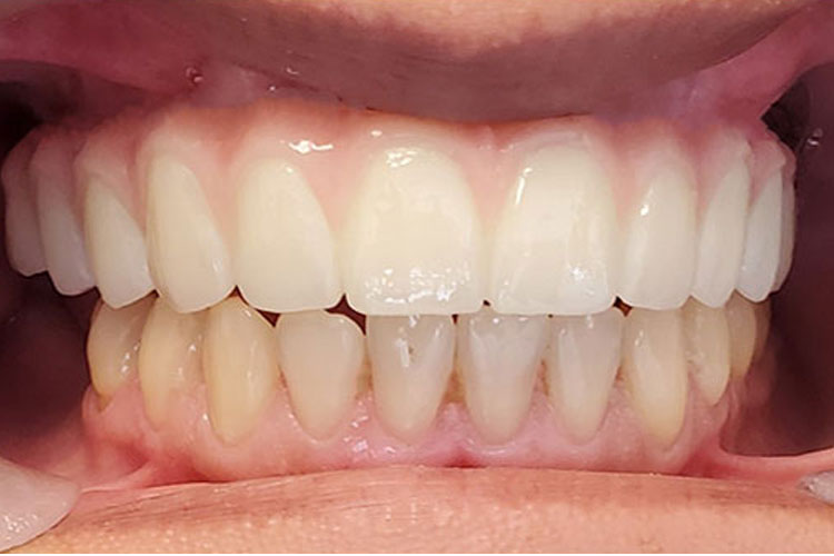 All-on-X Upper Arch Implant - After Image