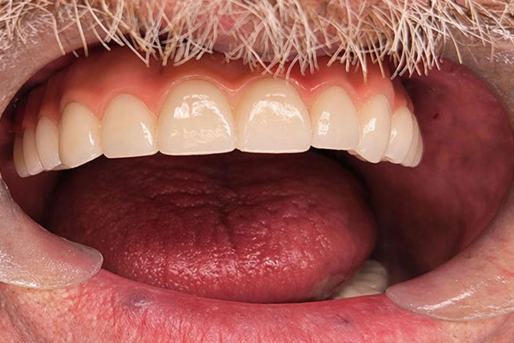 Full Upper Arch All-On-X Implant - After Image