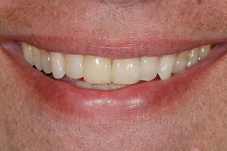 Single Tooth Implant - After