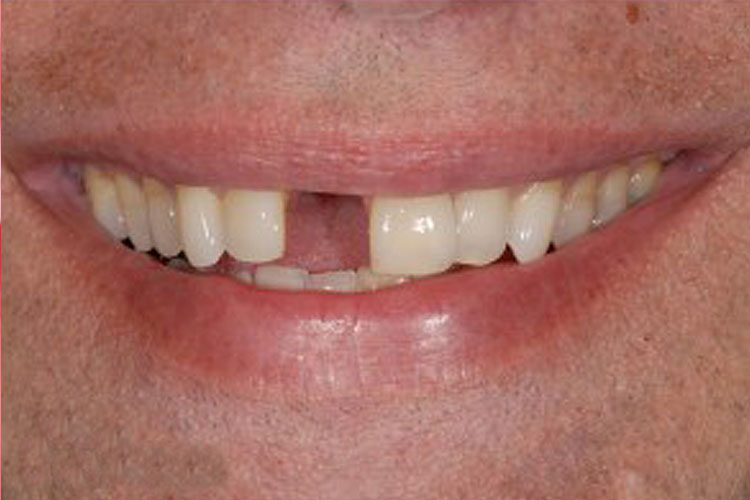 Single Tooth Implant - Before