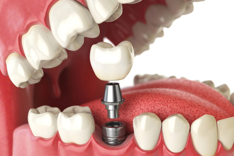 Single Tooth Implant