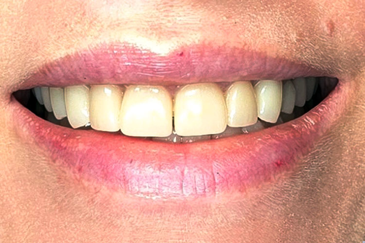 Smile Make Over: Fixed Spacing and Severe Wear - After Image