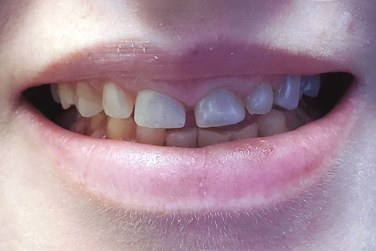 Smile Make Over: Fixed Spacing and Severe Wear - Before Image