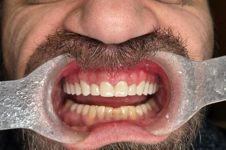 Full Upper Arch Rehab with Zirconia Crowns (After Image)