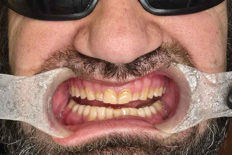 Full Upper Arch Rehab with Zirconia Crowns (Before Image)