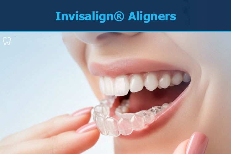 Invisalign Aligners