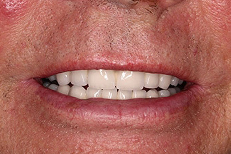 Patient: Man in his 60s - After Full-Arch Dental Implant