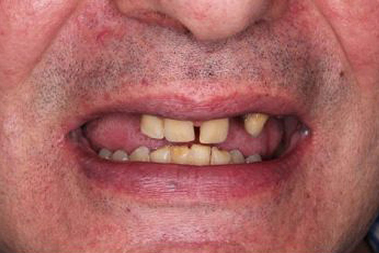 Patient: Man in his 50s - Before all-on-Dental Implant