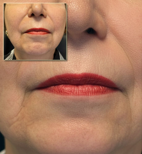 Botox Chin Treatment