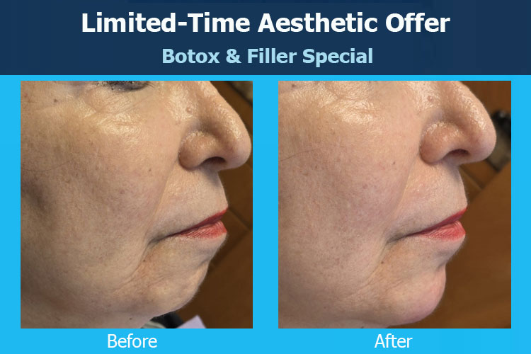 Botox & Filler Treatment