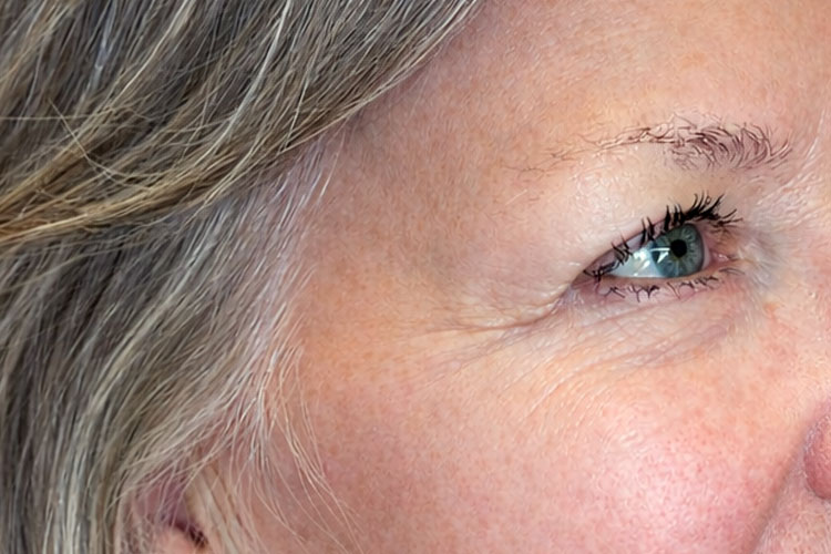 Botox Treatment of Crow's Feet (after)