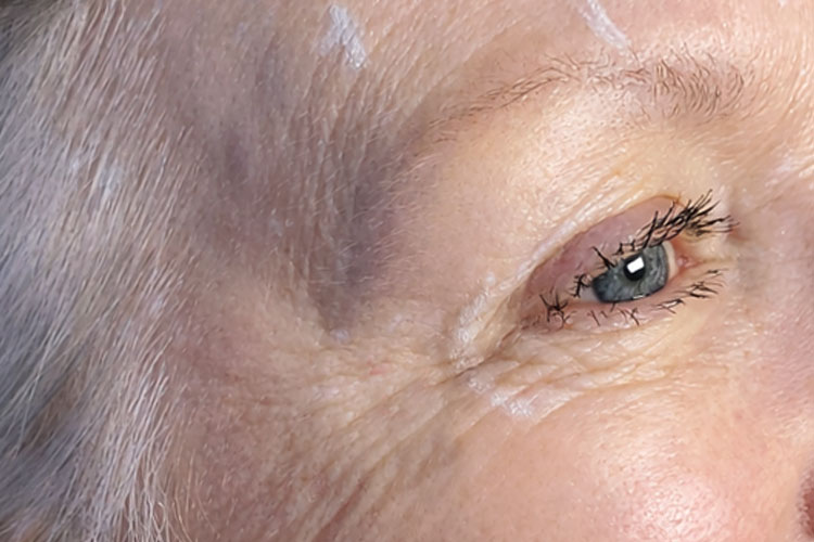 Botox Treatment of Crow's Feet (before)