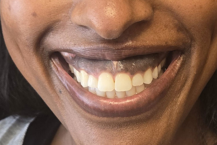 Correction of Gummy Smile with Botox - Before