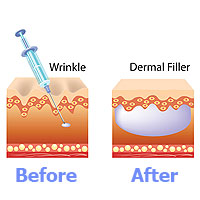 Dermal Filler Injection