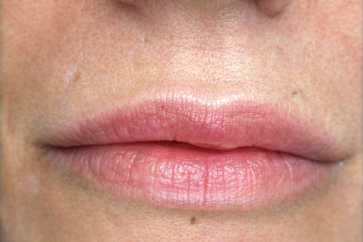 Dermal Filler: Lips Treatment (after image)